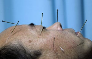 Un hombre se somete a acupuntura en un hospital universitario de Pekín. Foto: Reuters.