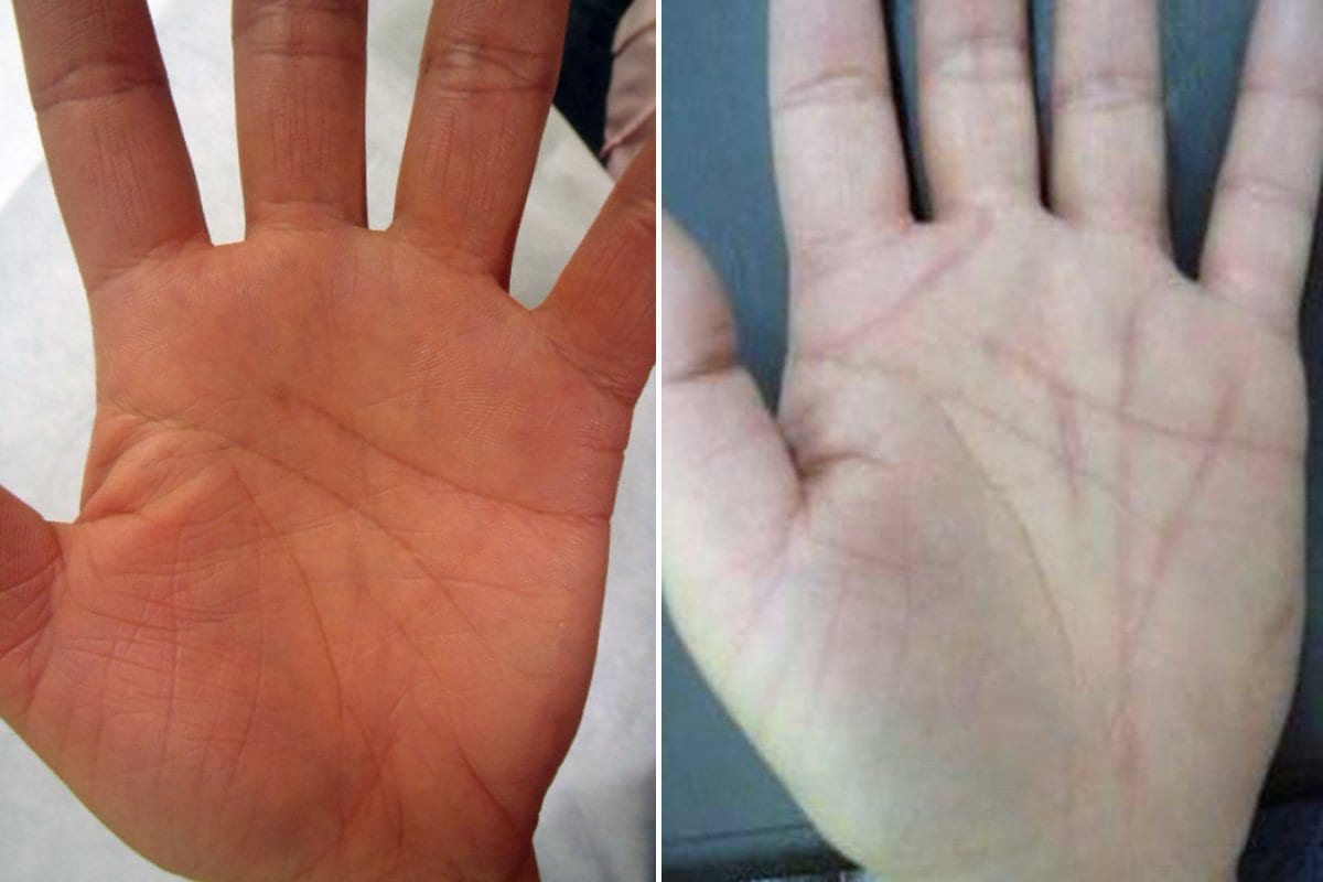 Palma de una mano, antes y después de la intervención. Foto: Clínica de Belleza Shonan.