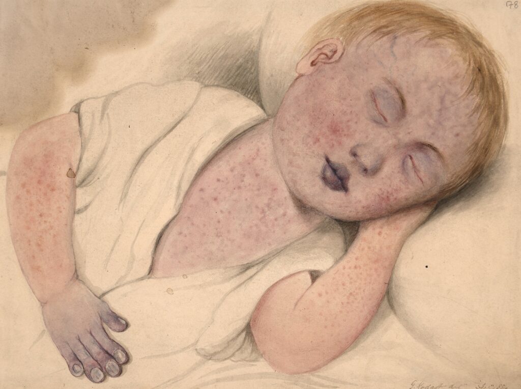 Acuarela de un niño de tres años con sarampión. Imagen: Archivo del Barts Health NHS Trust.